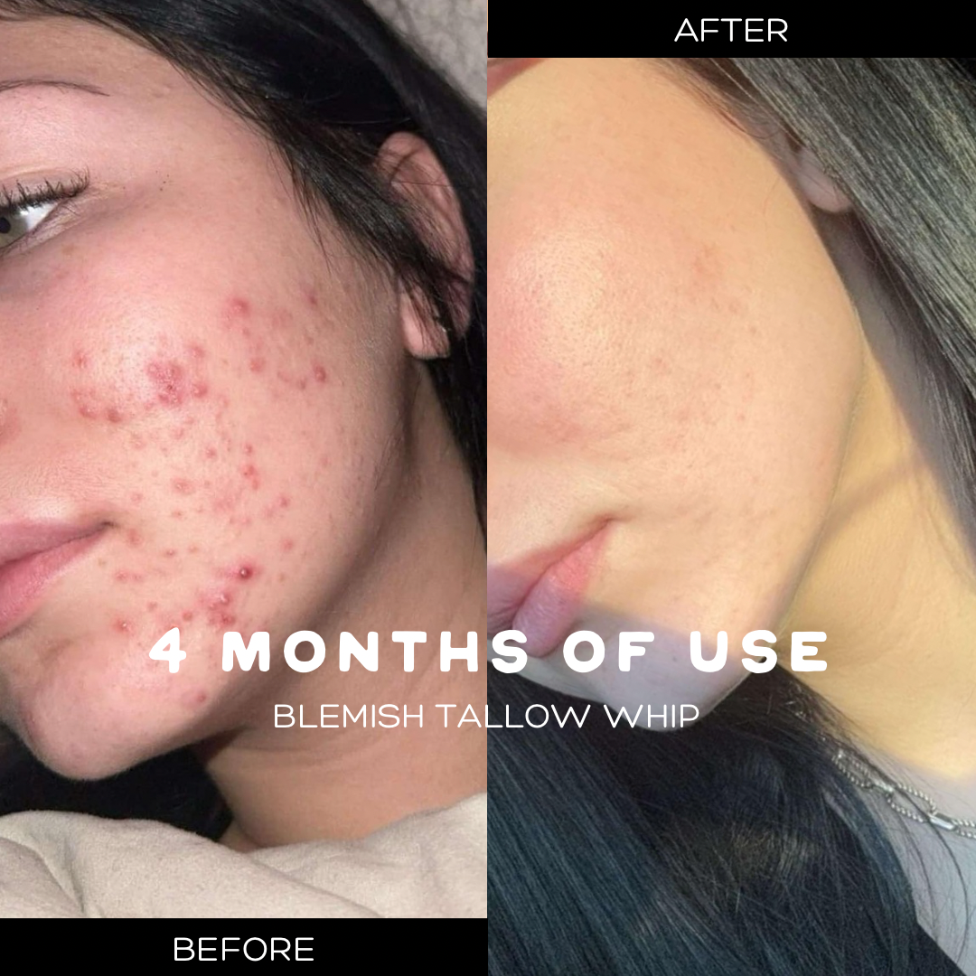 Blemish Tallow Whip, Acne-Prone/Inflamed Skin
