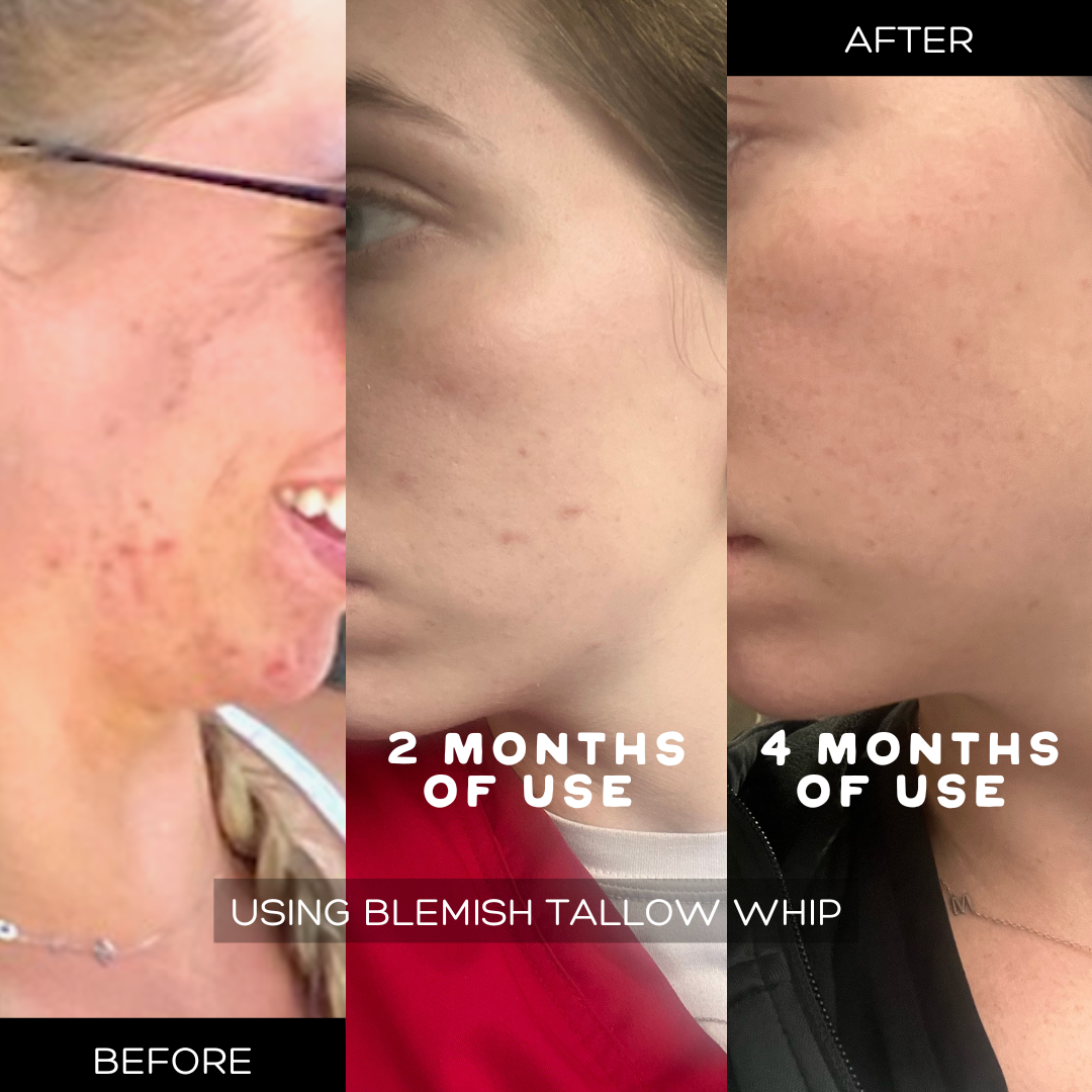 Blemish Tallow Whip, Acne-Prone/Inflamed Skin
